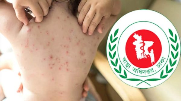 হাম ও উপসর্গ নিয়ে আরও ৩ শিশুর মৃত্যু