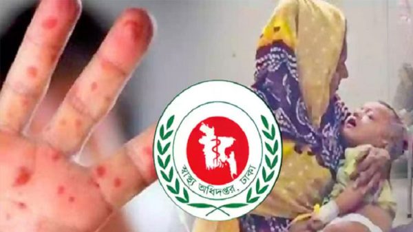 হাম ও হামের উপসর্গ নিয়ে আরও ৯ শিশুর মৃত্যু