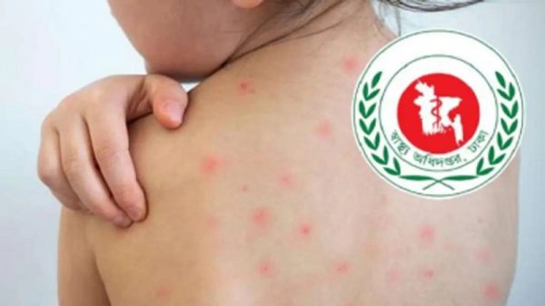 হামের উপসর্গ নিয়ে আরও ১১ শিশুর মৃত্যু