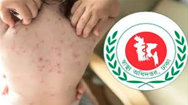 হাম ও হামের উপসর্গে আরও ৭ শিশুর মৃত্যু