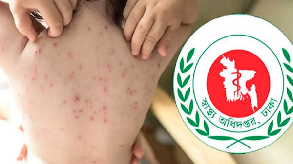 হামের উপসর্গ নিয়ে আরও ৪ শিশুর মৃত্যু