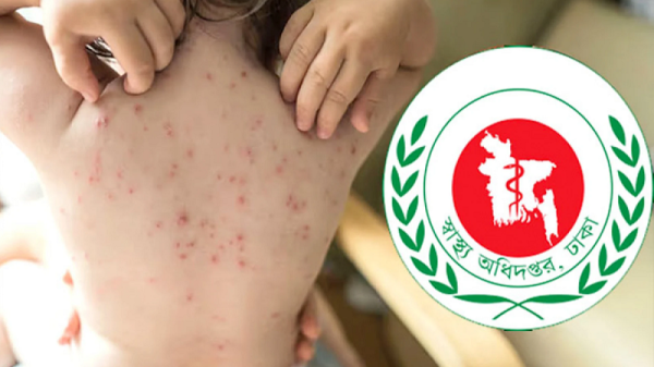 হাম ও হামের উপসর্গ নিয়ে আরও ৩ শিশুর মৃত্যু