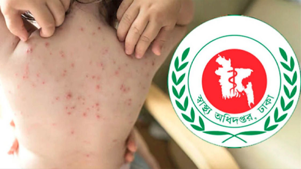 হাম ও হামের উপসর্গ নিয়ে আরও ৫ শিশুর মৃত্যু