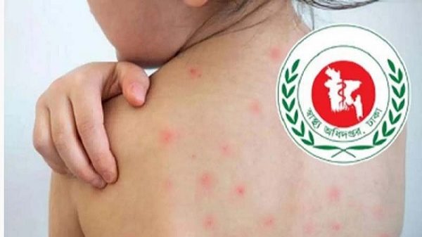 দেশে হামে আরও ১০ শিশুর মৃত্যু