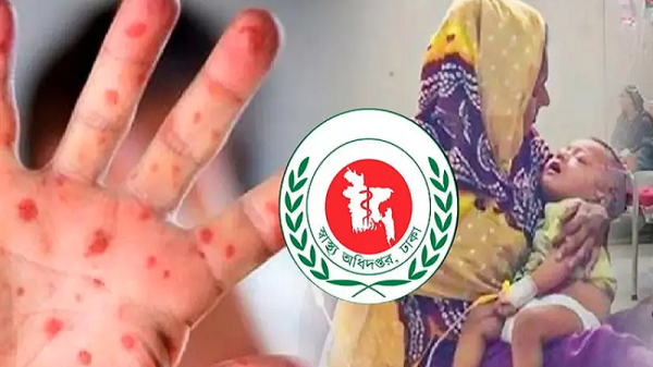 হাম ও লক্ষণে আরও ১৭ শিশুর মৃত্যু, ৩০০ ছাড়াল প্রাণহানি