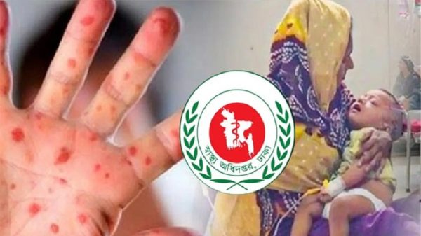 হাম ও হামের উপসর্গ নিয়ে আরও ১২ শিশুর মৃত্যু, মোট প্রাণহানি ৪৫১