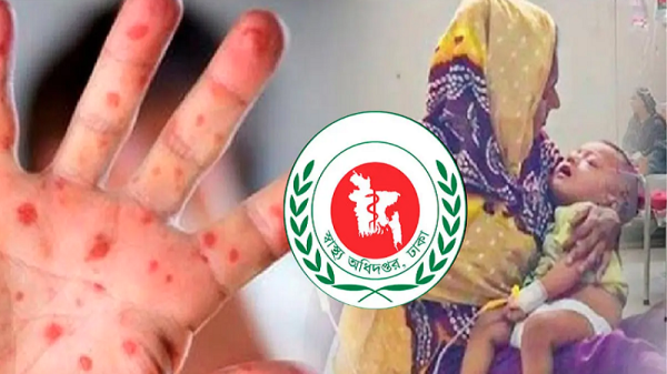হাম ও উপসর্গে আরও ৯ শিশুসহ মোট মৃত্যু ৪২৪ জন