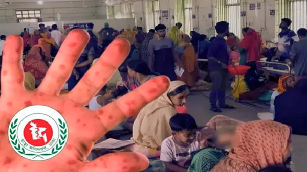 হাম ও হামের উপসর্গ নিয়ে দেশে আরও ১১ শিশুর মৃত্যু