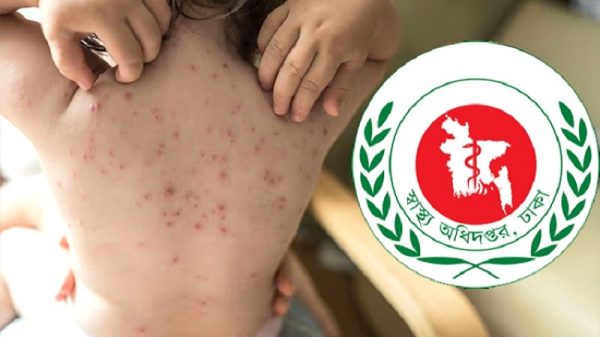হাম উপসর্গে আরও ৫ শিশুর মৃত্যু, আক্রান্ত ১০০৯