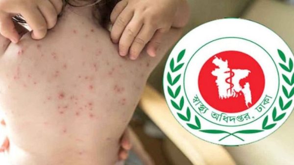 হামের উপসর্গে আরও ৬ শিশুর মৃত্যু