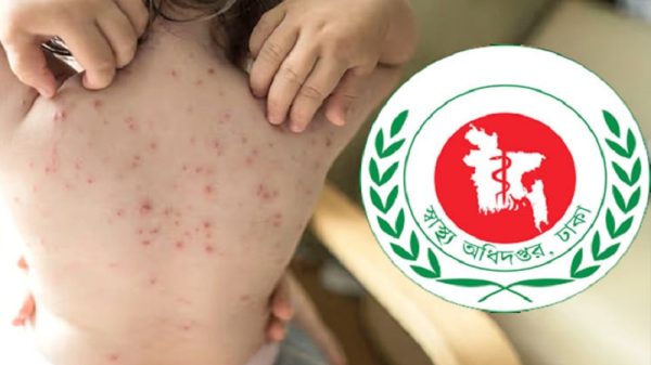হাম ও হামের উপসর্গ নিয়ে আরও ৩ শিশুর মৃত্যু