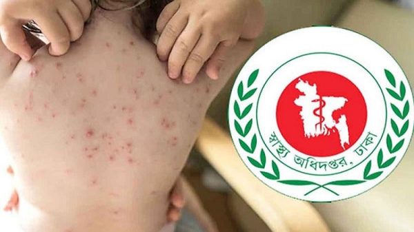 হামের উপসর্গ নিয়ে আরও ৮ শিশুর মৃত্যু