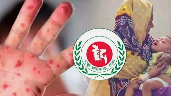হামের উপসর্গ নিয়ে আরো ৩ মৃত্যু