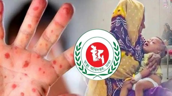 হাম উপসর্গ নিয়ে আরও ৫ শিশুর মৃত্যু, শনাক্ত ১৪৭