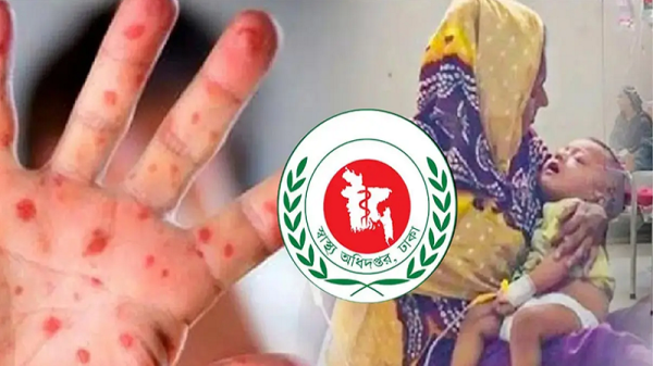 হামের উপসর্গে আরও ৩ শিশুর মৃত্যু, মোট ১০৮৭