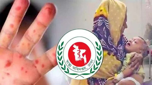 হাম উপসর্গে আরও ৭ জনের মৃত্যু, হাসপাতালে ১৩২৭